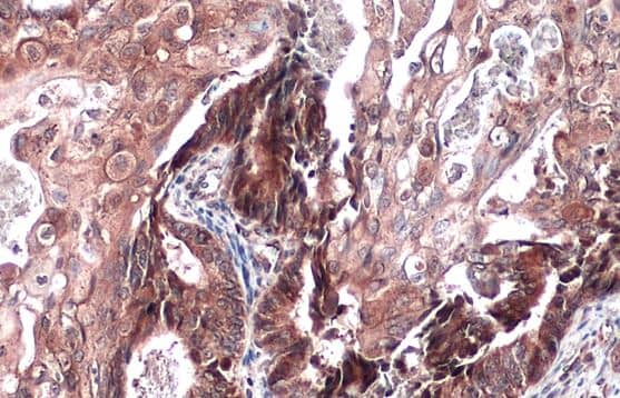 Immunohistochemistry-Paraffin: ST3 beta-Gal alpha-2,3-Sialyltransferase 1/ST3GAL1/SIAT4A Antibody [NBP1-31449] - Human ovarian cancer.SIAT4A stained by SIAT4A antibody diluted at 1:500.Antigen Retrieval: Citrate buffer, pH 6.0, 15 min