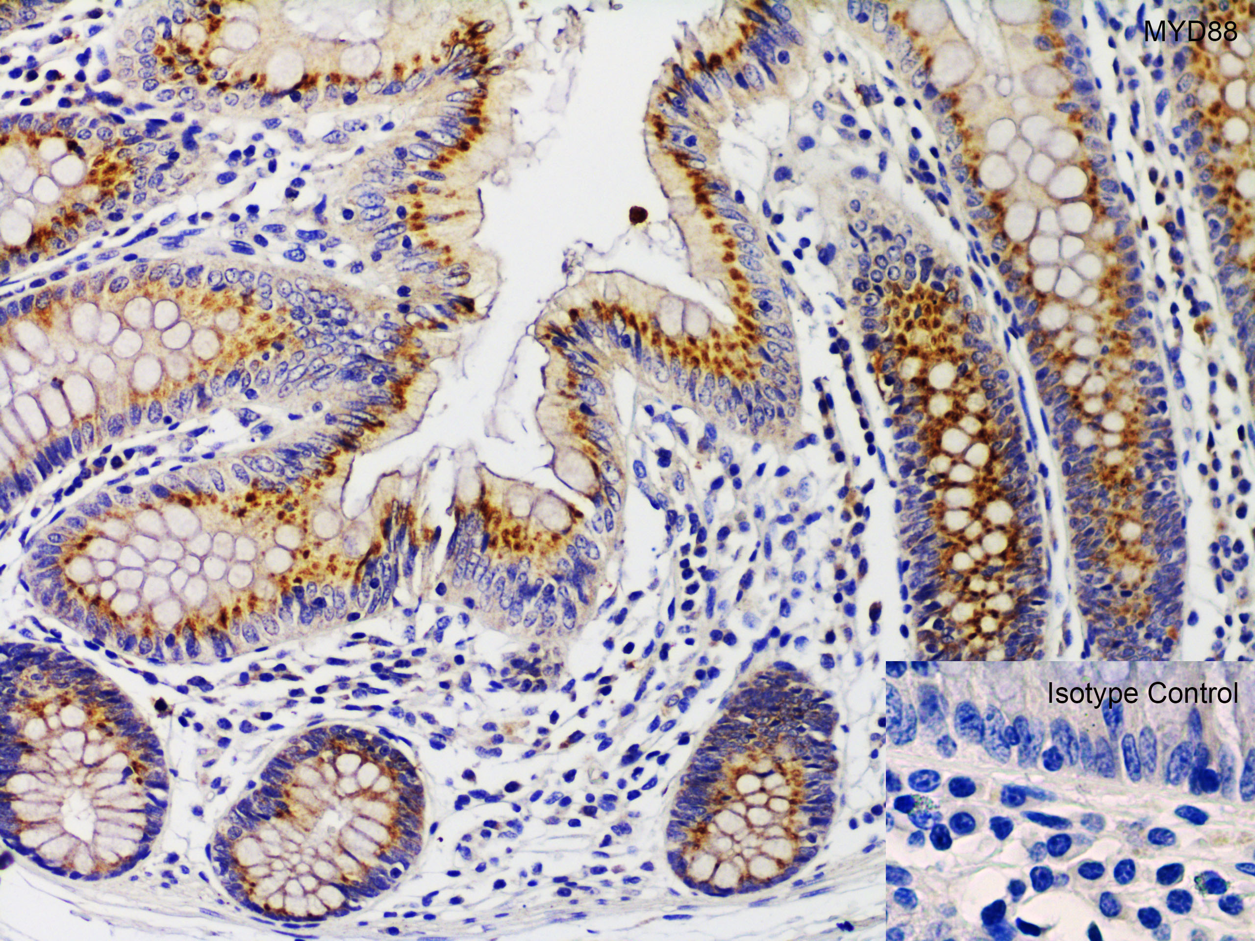 Immunohistochemistry: Rabbit Polyclonal MyD88 Antibody [NBP1-76465] - Immunohistochemistry Validation of MyD88 in Human Colon. Immunohistochemical analysis of paraffin-embedded human colon tissue using anti-MYD88 antibody at 1 ug/ml. Tissue was fixed with formaldehyde and blocked with 10% serum for 1 h at RT; antigen retrieval was by heat mediation with a citrate buffer (pH6). Samples were incubated with primary antibody overnight at 4C. A goat anti-rabbit IgG H&L (HRP) at 1/250 was used as secondary. Counter stained with Hematoxylin.