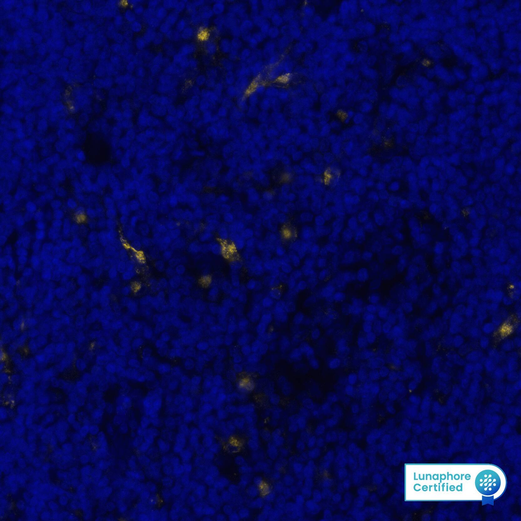 Versican was detected in immersion fixed paraffin-embedded sections of human Hodgkin Lymphoma using Rabbit Anti-Human/Mouse Versican, Polyclonal Antibody (Catalog # NBP1-85432) at 10ug/mL at 37° Celsius for 8 minutes. Before incubation with the primary antibody, tissue underwent an all-in-one dewaxing and antigen retrieval preprocessing using PreTreatment Module (PT Module) and Dewax and HIER Buffer H (pH 9; Epredia Catalog # TA-999-DHBH). Tissue was stained using the Alexa Fluor™ Plus 555 Goat anti-Rabbit IgG Secondary Antibody at 1:100 at 37 ° Celsius for 2 minutes. (Yellow; Lunaphore Catalog # DR555RB) and counterstained with DAPI (blue; Lunaphore Catalog # DR100). Specific staining was localized to the cytoplasm of connective tissue/stroma. Protocol available in COMET™ Panel Builder.