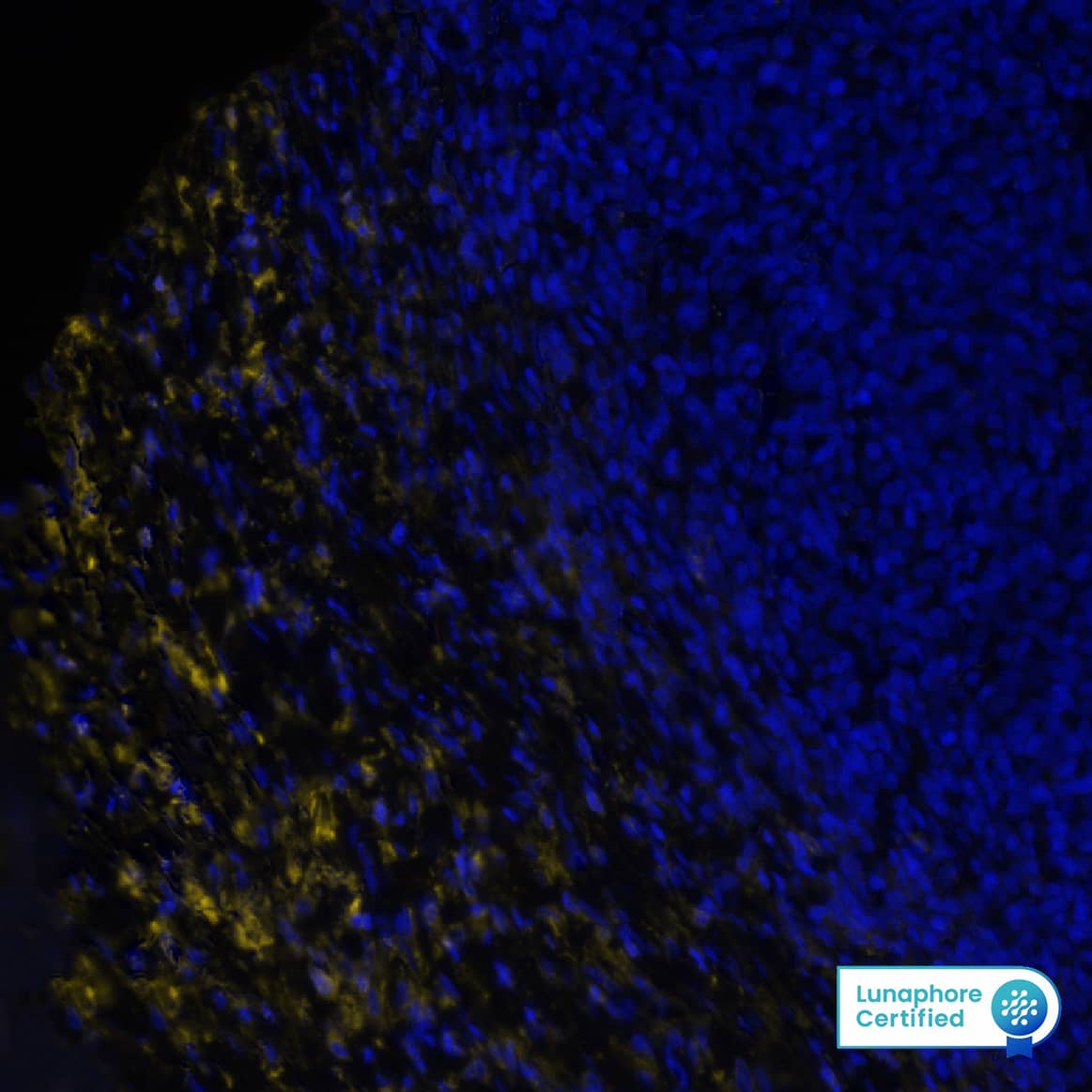 Versican was detected in immersion fixed paraffin-embedded sections of human B-Cell Lymphoma using Rabbit Anti-Human/Mouse Versican, Polyclonal Antibody (Catalog #  NBP1-85432) at 10ug/mL at 37° Celsius for 8 minutes. Before incubation with the primary antibody, tissue underwent an all-in-one dewaxing and antigen retrieval preprocessing using PreTreatment Module (PT Module) and Dewax and HIER Buffer H (pH 9; Epredia Catalog # TA-999-DHBH). Tissue was stained using the Alexa Fluor™ Plus 555 Goat anti-Rabbit IgG Secondary Antibody at 1:100 at 37 ° Celsius for 2 minutes. (Yellow; Lunaphore Catalog # DR555RB) and counterstained with DAPI (blue; Lunaphore Catalog # DR100). Specific staining was localized to the cytoplasm of connective tissue/stroma. Protocol available in COMET™ Panel Builder.