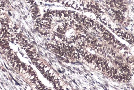 Immunohistochemistry-ParaffinFOXM1 Antibody [NBP2-16520] - Human endometrial carcinoma.FOXM1 stained by FOXM1 antibody diluted at 1:500.Antigen Retrieval: Citrate buffer, pH 6.0, 15 min.