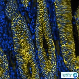 E-Cadherin was detected in immersion fixed paraffin-embedded sections of human colon cancer using Mouse Anti-Human E-Cadherin Monoclonal Antibody (Catalog # NBP2-19051) at 1 µg/mL at 37 ° Celsius for 4 minutes. Before incubation with the primary antibody, tissue underwent an all-in-one dewaxing and antigen retrieval preprocessing using PreTreatment Module (PT Module) and Dewax and HIER Buffer H (pH 9). Tissue was stained using the Alexa Fluor™ 647 Goat anti-Mouse IgG Secondary Antibody at 1:200 at 37 ° Celsius for 2 minutes. (Yellow; Lunaphore Catalog # DR647MS) and counterstained with DAPI (blue; Lunaphore Catalog # DR100). Specific staining was localized to the membrane. Protocol available in COMET™ Panel Builder.