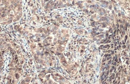 Immunohistochemistry-Paraffin-ULBP1 Antibody [NBP2-20808] -  Human cervical carcinoma.ULBP1 stained by ULBP1 antibody [N1C3] diluted at 1:500.Antigen Retrieval: Citrate buffer, pH 6.0, 15 min