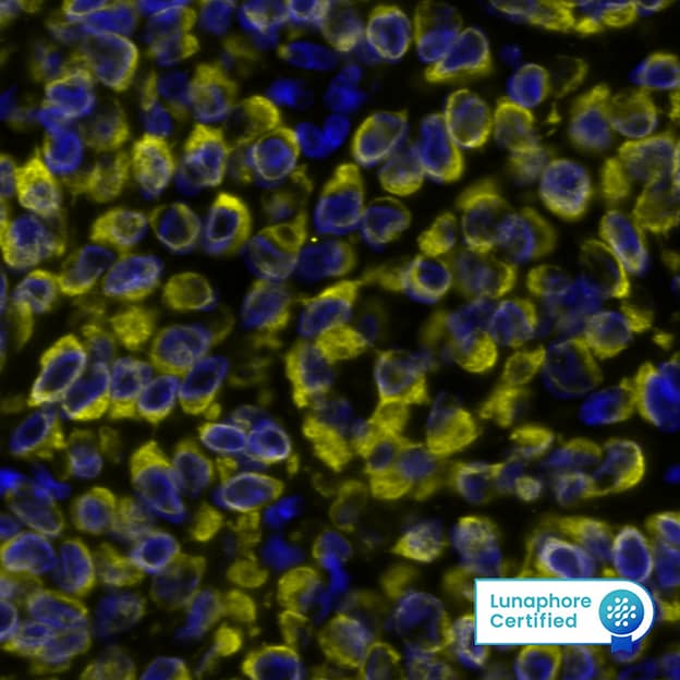 Pan-Cytokeratin Antibody was detected in immersion fixed paraffin-embedded sections of human Breast Tumor using Mouse Anti-Human Cytokeratin, pan Monoclonal Antibody (Catalog # NBP2-29429) at 1:500 at 37 ° Celsius for 4 minutes. Before incubation with the primary antibody, tissue underwent an all-in-one dewaxing and antigen retrieval preprocessing using PreTreatment Module (PT Module) and Dewax and HIER Buffer H (pH 9; Epredia Catalog # TA-999-DHBH). Tissue was stained using the Alexa Fluor&amp;#8482; 555 Goat anti-Mouse IgG Secondary Antibody at 1:100 at 37 ° Celsius for 2 minutes. (Yellow; Lunaphore Catalog # &lt;A class=