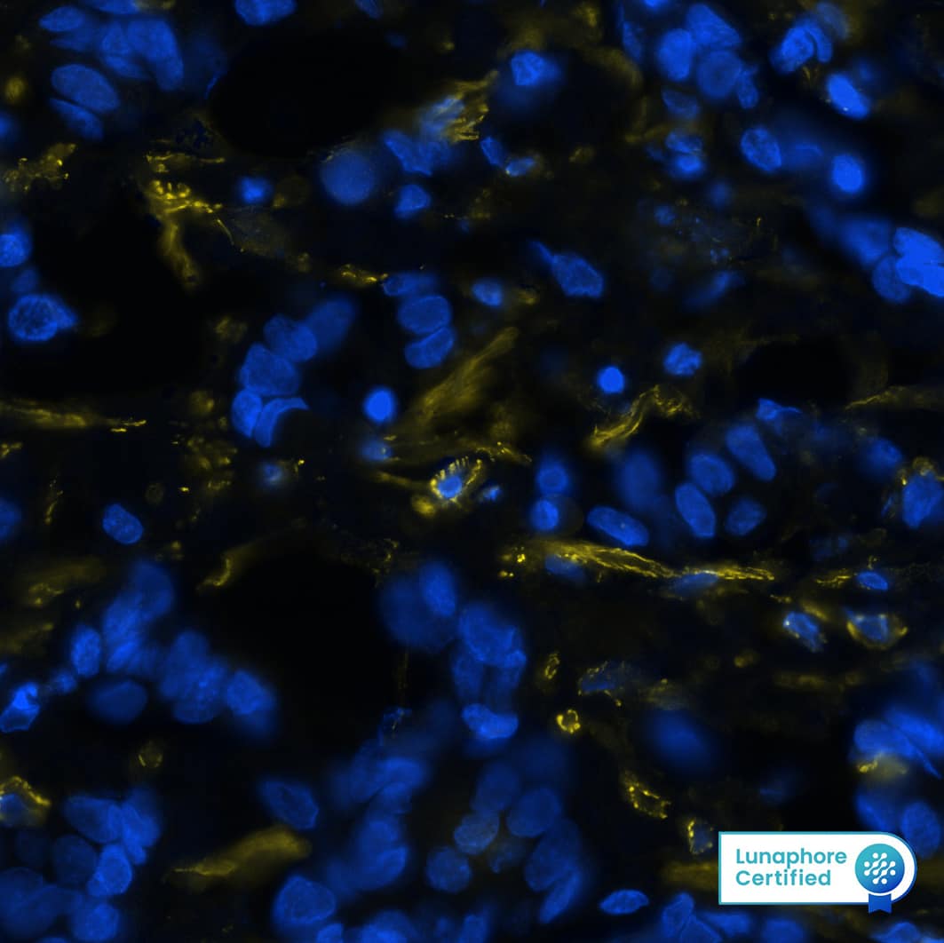  alpha -Smooth Muscle Actin was detected in immersion fixed paraffin-embedded sections of human breast cancer using Mouse Anti-Human/Mouse/Rat  alpha -Smooth Muscle Actin Monoclonal Antibody (Novus Catalog # NBP2-33006) at 0.25ug/mL at 37 ° Celsius for 2 minutes. Before incubation with the primary antibody, tissue underwent an all-in-one dewaxing and antigen retrieval preprocessing using PreTreatment Module (PT Module) and Dewax and HIER Buffer H (pH 9). Tissue was stained using the Alexa Fluor™ 555 Goat anti-Mouse IgG Secondary Antibody at 1:100 at 37 ° Celsius for 2 minutes. (Yellow; Lunaphore Catalog # DR555MS) and counterstained with DAPI (blue; Lunaphore Catalog # DR100). Specific staining was localized to the cytoplasm and cytoskeleton. Protocol available in COMET™ Panel Builder.