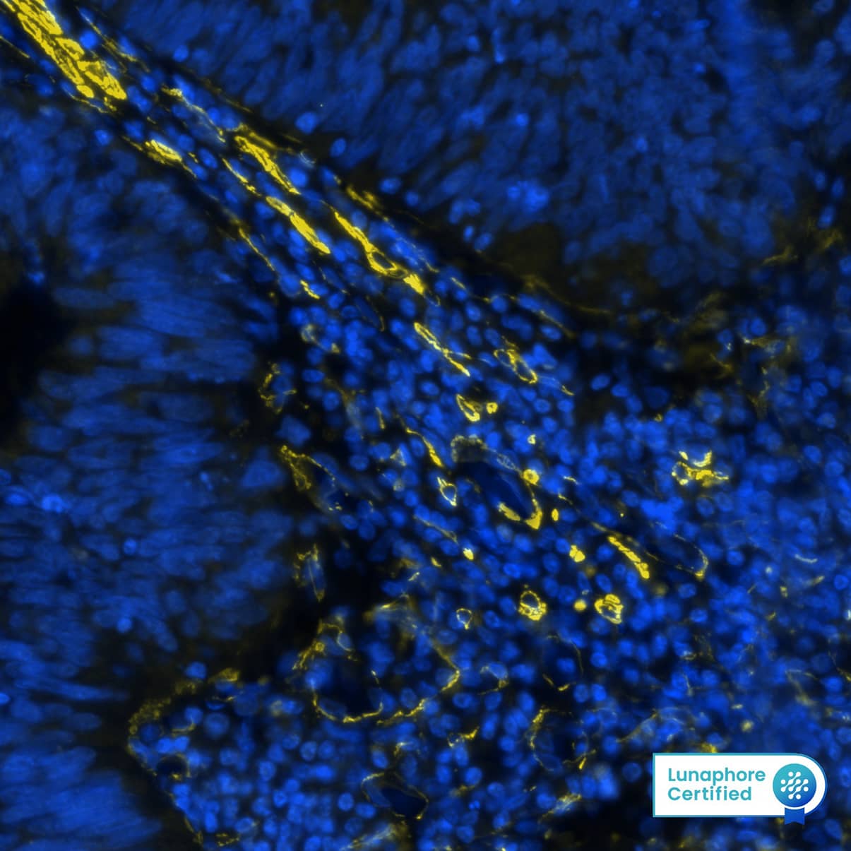  alpha -Smooth Muscle Actin was detected in immersion fixed paraffin-embedded sections of human colon cancer using Mouse Anti-Human/Mouse/Rat  alpha -Smooth Muscle Actin Monoclonal Antibody (Novus Catalog # NBP2-33006) at 0.25ug/mL at 37 ° Celsius for 2 minutes. Before incubation with the primary antibody, tissue underwent an all-in-one dewaxing and antigen retrieval preprocessing using PreTreatment Module (PT Module) and Dewax and HIER Buffer H (pH 9). Tissue was stained using the Alexa Fluor™ 555 Goat anti-Mouse IgG Secondary Antibody at 1:100 at 37 ° Celsius for 2 minutes. (Yellow; Lunaphore Catalog # DR555MS) and counterstained with DAPI (blue; Lunaphore Catalog # DR100). Specific staining was localized to the cytoplasm and cytoskeleton. Protocol available in COMET™ Panel Builder.