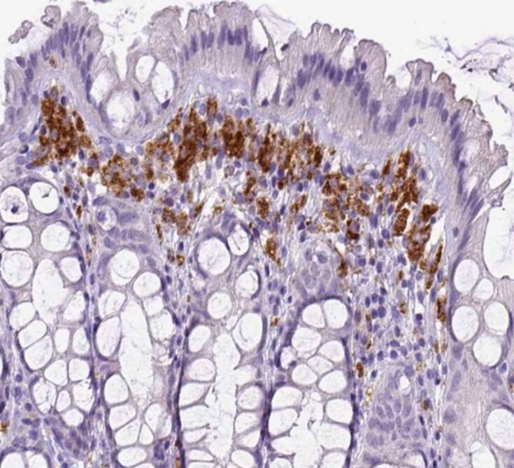  Staining of human colon shows strong cytoplasmic positivity in lymphoid cells.