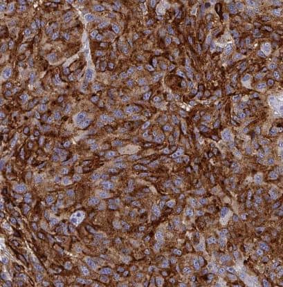 Immunohistochemistry-Paraffin-Syntaxin 7 Antibody (CL0257)-NBP2-52893- Staining of human malignant melanoma shows moderate to strong cytoplasmic positivity in tumor cells.