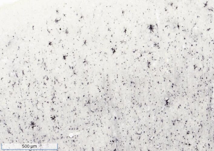 Ferritin (Light chain) staining in human AD brain. Image from a verified customer review.