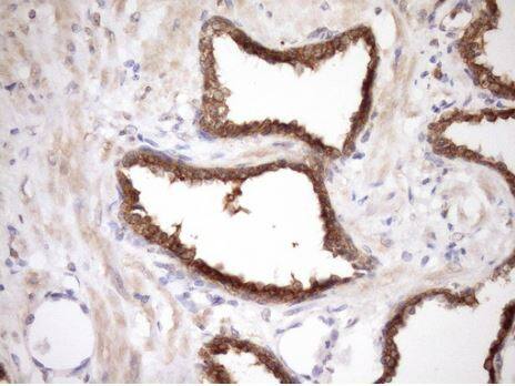 Immunohistochemistry-Paraffin-MRG15 Antibody (OTI5D2) - Azide and BSA Free [NBP2-72778] - Carcinoma of Human prostate tissue using anti-MORF4L1 mouse monoclonal antibody. (Heat-induced epitope retrieval by Tris-EDTA, pH8.0.