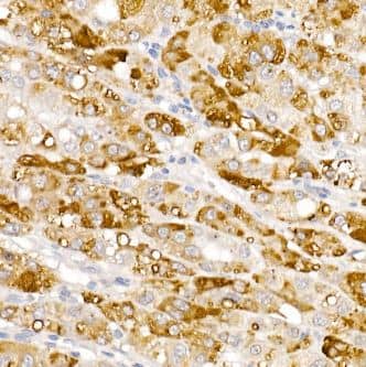 Immunohistochemistry-Paraffin: HSD17B13 Antibody [NBP3-04837] -Human liver cancer using HSD17B13 Rabbit pAb at dilution of 1:100 (40x lens). High pressure antigen retrieval performed with 0.01M Citrate Buffer (pH 6.0) prior to IHC staining.