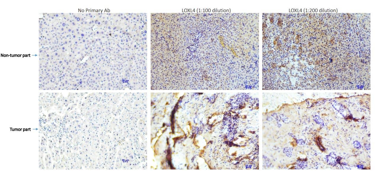 Immunohistochemistry-paraffin: LOXL4 Antibody [NBP3-04898] - LOXL4 was tested in Human HCC tissue for IHC. Primary Ab: LOXL4 antibody dilution at 1:100 and 1:200 (diluted in 10% goat anti rabbit serum). Secondary Ab: biotin anti rabbit (BD550880) diluted in 1:200, 0.025% PBST. Image from verified customer review.