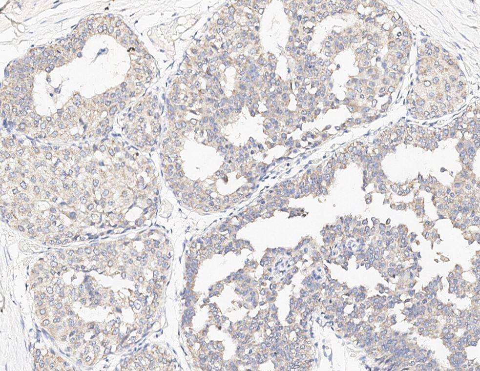 Immunohistochemistry-Paraffin-NBP3-20170-SMPDL3A Antibody - Azide and BSA Free-Staining of human SMPDL3A in human breast carcinoma with rabbit polyclonal antibody at 1:100 dilution, formalin-fixed paraffin embedded sections.