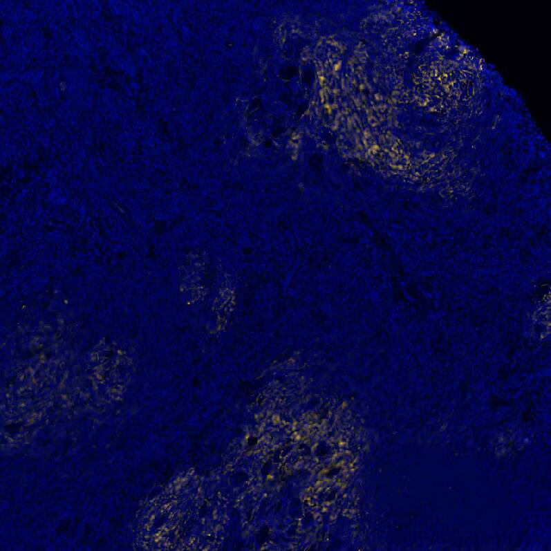 CD21 was detected in immersion fixed paraffin-embedded sections of human Hodgkin's Lymphoma using Rabbit Anti-Human CD21, Monoclonal Antibody (Catalog # NBP3-20354) at 1:2000 at 37° Celsius for 4 minutes. Before incubation with the primary antibody, tissue underwent an all-in-one dewaxing and antigen retrieval preprocessing using PreTreatment Module (PT Module) and Dewax and HIER Buffer H (pH 9; Epredia Catalog #TA-999-DHBH).Tissue was stained using the Alexa Fluor™ Plus 555 Goat anti-Rabbit IgG Secondary Antibody at 1:100 at 37 ° Celsius for 2 minutes. (Yellow; Lunaphore Catalog # DR555RB) and counterstained with DAPI (blue; Lunaphore Catalog # DR100). Specific staining was localized to the membrane. Protocol available in COMET™ Panel Builder. 