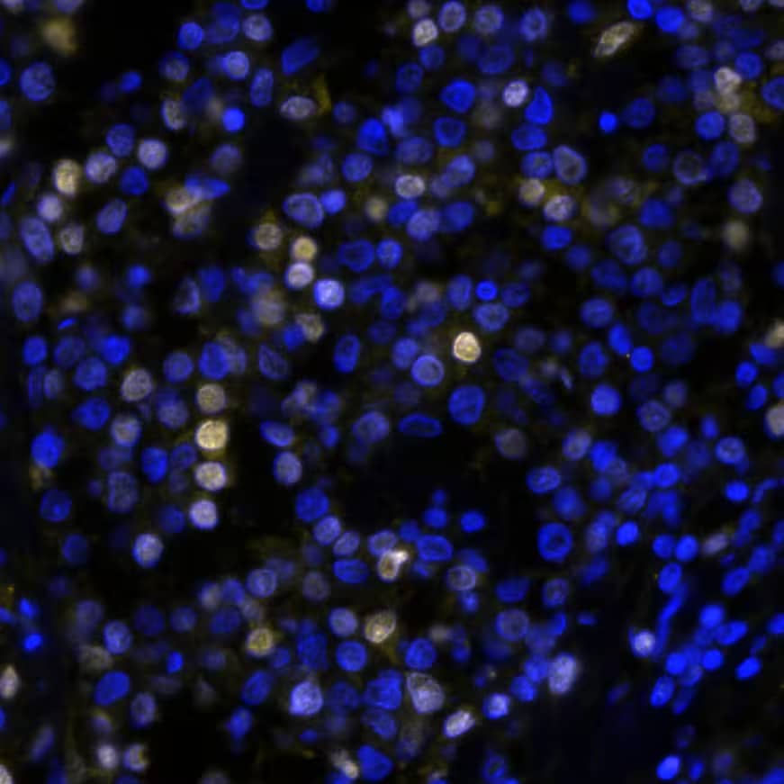 IRF4 was detected in immersion fixed paraffin-embedded sections of human Hodgkin's Lymphoma using Rabbit Anti-Human IRF4, Monoclonal Antibody (Catalog #NBP3-20550) at 10ug/mL at 37° Celsius for 4 minutes. Before incubation with the primary antibody, tissue underwent an all-in-one dewaxing and antigen retrieval preprocessing using PreTreatment Module (PT Module) and Dewax and HIER Buffer H (pH 9; Epredia Catalog # TA-999-DHBH). Tissue was stained using the Alexa Fluor™ Plus 647 Goat anti-Rabbit IgG Secondary Antibody at 1:200 at 37 ° Celsius for 2 minutes. (Yellow; Lunaphore Catalog # DR647RB) and counterstained with DAPI (blue; Lunaphore Catalog # DR100). Specific staining was localized to the nucleus. Protocol available in COMET™ Panel Builder.