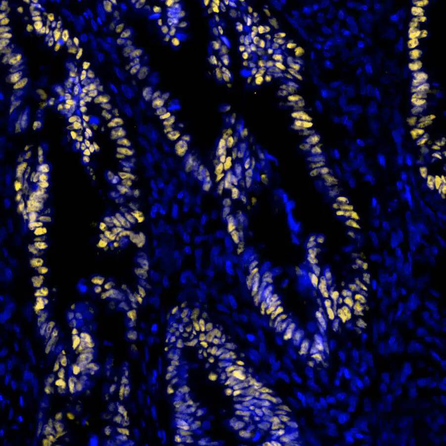 p53 was detected in immersion fixed paraffin-embedded sections of human Colon Tumor using Mouse Anti-Human p53 Monoclonal Antibody at 12ug/mL at 37°Celsius for 8 minutes. Before incubation with the primary antibody, tissue underwent an all-in-one dewaxing and antigen retrieval preprocessing using PreTreatment Module (PT Module) and Dewax and HIER Buffer H (pH 9; Epredia Catalog # TA-999-DHBH). Tissue was stained using the Alexa Fluor™ 555 Goat anti-Mouse IgG Secondary Antibody at 1:100 at 37°Celsius for 2 minutes. (Yellow; Lunaphore Catalog # DR555MS) and counterstained with DAPI (blue; Lunaphore Catalog # DR100). Specific staining was localized to the astrocytes showing nuclear staining. Protocol available in COMET™ Panel Builder.