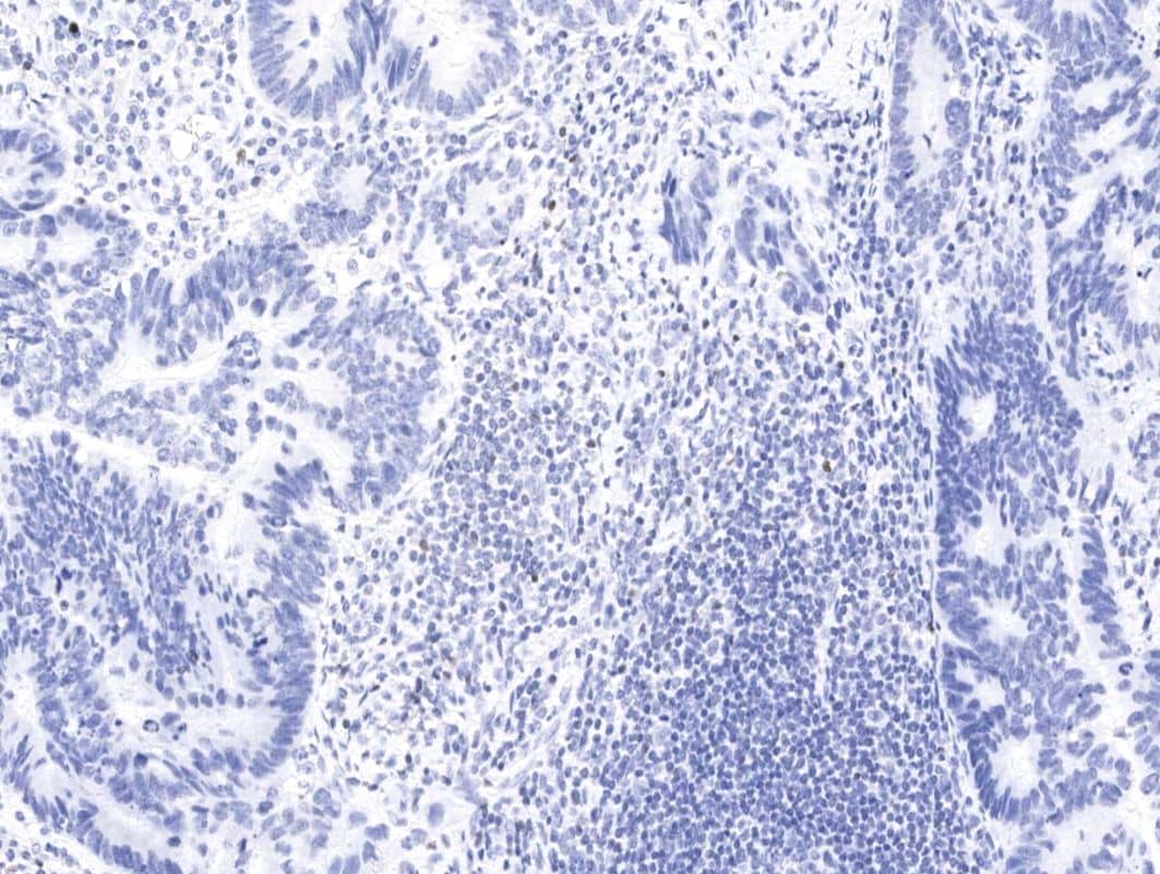 IHC-P-NBP3-21484-FoxP3 Antibody (02)-Staining of human FOXP3 in human carcinoma of sigmoid with mouse monoclonal antibody at 1:200 dilution, formalin-fixed paraffin embedded sections.