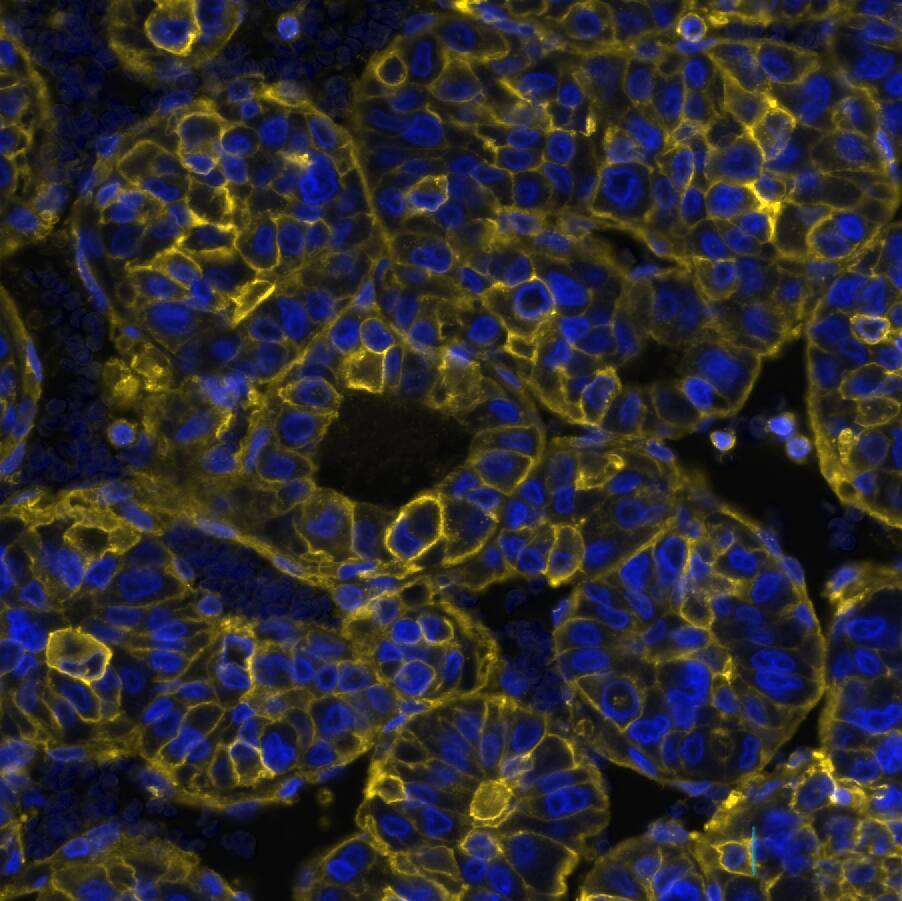 HLA ABC was detected in immersion fixed paraffin-embedded sections of human Liver Tumor using Rabbit Anti-Human HLA ABC, Monoclonal Antibody at 0.15ug/mL at 37°Celsius for 4 minutes. Before incubation with the primary antibody, tissue underwent an all-in-one dewaxing and antigen retrieval preprocessing using PreTreatment Module (PT Module) and Dewax and HIER Buffer H (pH 9; Epredia Catalog # TA-999-DHBH). Tissue was stained using the Alexa Fluor™ Plus 555 Goat anti-Rabbit IgG Secondary Antibody at 1:100 at 37°Celsius for 2 minutes. (Yellow; Lunaphore Catalog # DR555RB) and counterstained with DAPI (blue; Lunaphore Catalog # DR100). Specific staining was localized to the membrane. Protocol available in COMET™ Panel Builder.