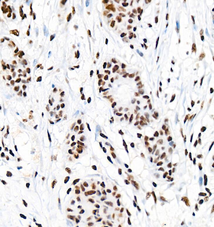 Analysis of paraffin-embedded Human breast cancer tissue using [KD Validated] EFTUD2 Rabbit mAb at a dilution of 1:1500 (40x lens). High pressure antigen retrieval performed with 0.01M Citrate Buffer (pH 6.0) prior to IHC staining.