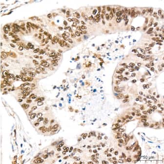 Immunohistochemistry-Paraffin:REPIN1 Antibody (2X2E9)-Human colon carcinoma tissue using REPIN1 Rabbit mAb at a dilution of 1:200 (40x lens). High pressure antigen retrieval performed with 0.01M Citrate Buffer (pH 6.0) prior to IHC staining.