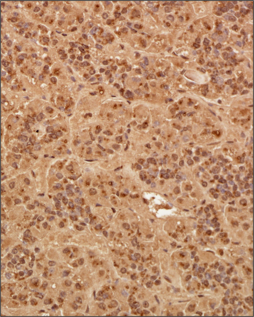 Analysis of a FFPE tissue section of human pituatary gland using 1:200 dilution of Pit1 antibody (NBP3-38647). The staining was developed using HRP labeled anti-rabbit secondary antibody and DAB reagent, and nuclei of cells were counter-stained with hematoxylin.