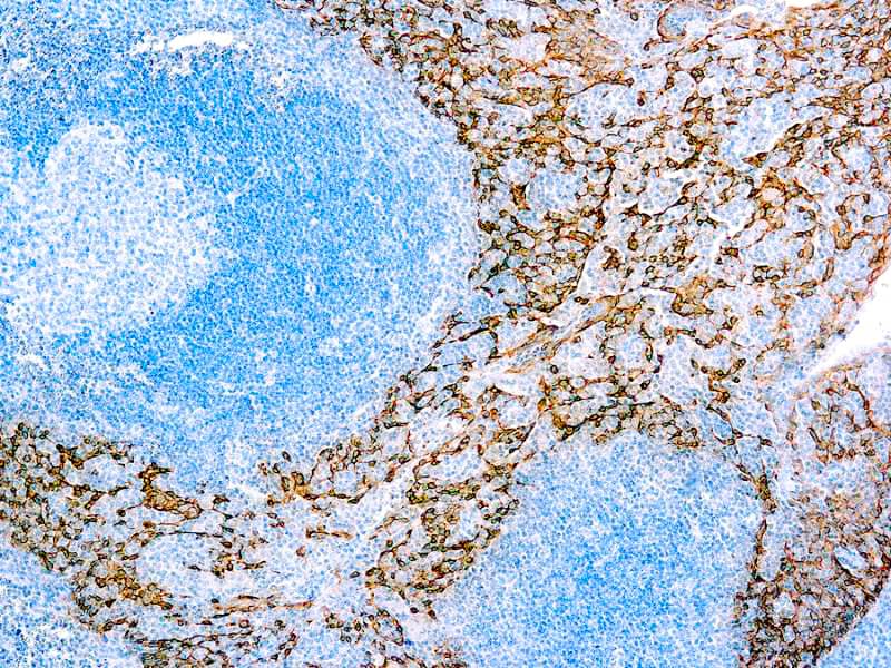 Formalin fixed paraffin embedded human tonsil stained with Cytokeratin 5/14.