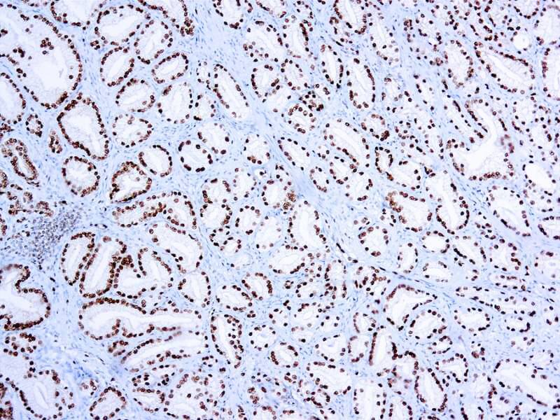 Formalin fixed paraffin embedded human prostate carcinoma stained with ERG antibody.