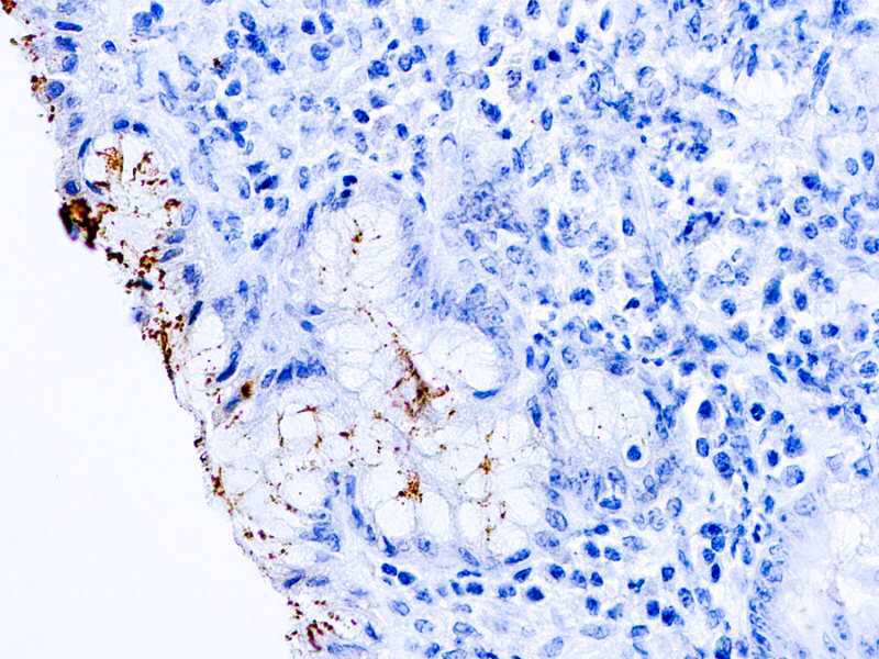 Formalin fixed paraffin embedded human stomach infected with H. pylori and stained with H. pylori antibody.