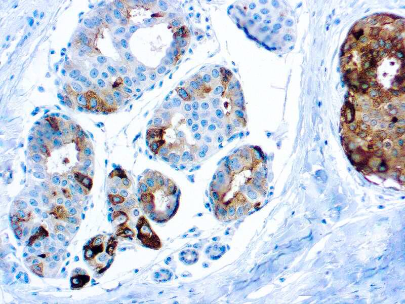 Formalin fixed paraffin embedded human breast carcinoma stained with PIP.