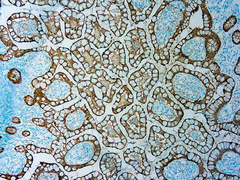 Formalin fixed paraffin embedded human Colorectal carcinoma stained with Villin 1.