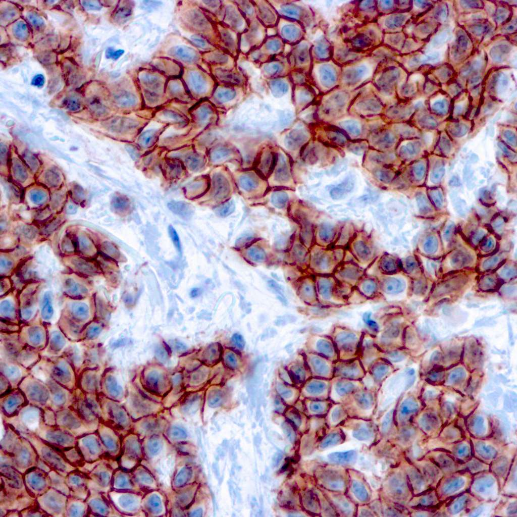 Formalin fixed paraffin embedded human Breast carcinoma stained with p120 Catenin.