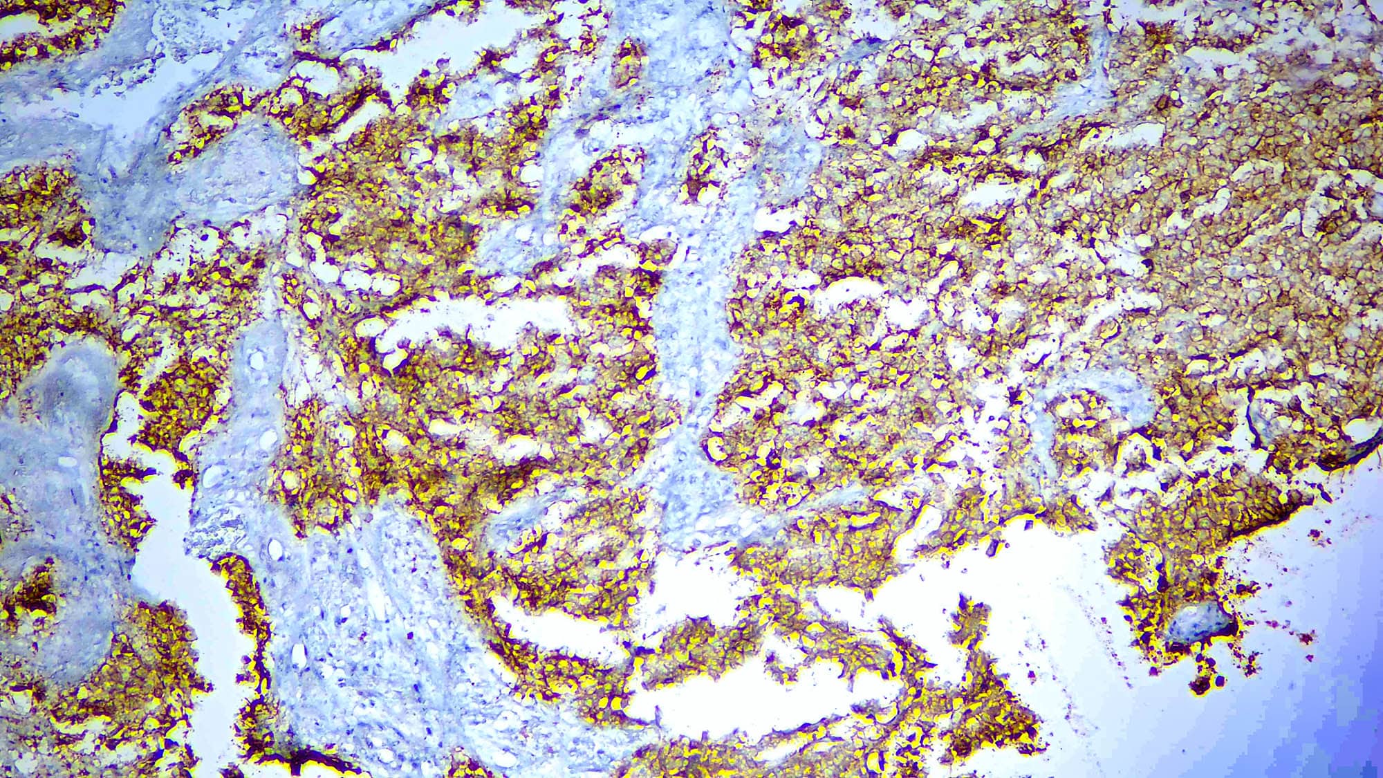 Formalin fixed paraffin embedded human gastric carcinoma tissue stained with Claudin18.2.
