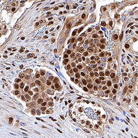 p300 was detected in immersion fixed paraffin-embedded sections of human colon cancer tissue using Goat Anti-Human p300 Antigen Affinity-purified Polyclonal Antibody (Catalog # AF3789) at 5 µg/mL for 1 hour at room temperature followed by incubation with the Anti-Goat IgG VisUCyte™ HRP Polymer Antibody (Catalog # VC004). Tissue was stained using DAB (brown) and counterstained with hematoxylin (blue). Specific staining was localized to nuclei. View our protocol for IHC Staining with VisUCyte HRP Polymer Detection Reagents.