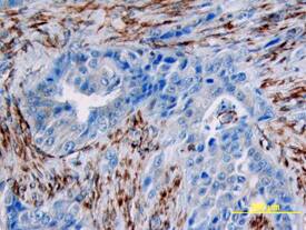 p53 phosphorylated at S46 was detected in immersion fixed paraffin-embedded sections of human breast array using Rabbit Anti-Human Phospho-p53 (S46) Antigen Affinity-purified Polyclonal Antibody (Catalog # AF1489) at 15 µg/mL overnight at 4 °C. Tissue was stained using the Anti-Rabbit HRP-DAB Cell & Tissue Staining Kit (brown; Catalog # CTS005) and counterstained with hematoxylin (blue). View our protocol for Chromogenic IHC Staining of Paraffin-embedded Tissue Sections.