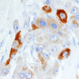 pIgR was detected in formalin fixed paraffin-embedded sections of human liver cancer tissue using Mouse Anti-Human pIgR Monoclonal Antibody (Catalog # MAB27171) at 15 µg/mL overnight at 4 °C. Tissue was stained using the Anti-Mouse HRP-DAB Cell & Tissue Staining Kit (brown; Catalog # CTS002) and counterstained with hematoxylin (blue). Specific staining was localized in the cytoplasm. View our protocol for Chromogenic IHC Staining of Paraffin-embedded Tissue Sections.