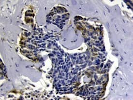 u-Plasminogen Activator (uPA)/Urokinase was detected in immersion fixed paraffin-embedded sections of human breast cancer tissue using Goat Anti-Human u-Plasminogen Activator (uPA)/Urokinase Antigen Affinity-purified Polyclonal Antibody (Catalog # AF1310) at 10 µg/mL overnight at 4 °C. Before incubation with the primary antibody tissue was subjected to heat-induced epitope retrieval using Antigen Retrieval Reagent-Basic (Catalog # CTS013). Tissue was stained using the Anti-Goat HRP-DAB Cell & Tissue Staining Kit (brown; Catalog # CTS008) and counterstained with hematoxylin (blue). View our protocol for Chromogenic IHC Staining of Paraffin-embedded Tissue Sections.