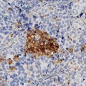 uPAR was detected in immersion fixed paraffin-embedded sections of human lung cancer tissue using Goat Anti-Human uPAR Antigen Affinity-purified Polyclonal Antibody (Catalog # AF807) at 1 µg/mL for 1 hour at room temperature followed by incubation with the Anti-Goat IgG VisUCyte™ HRP Polymer Antibody (VC004). Tissue was stained using DAB (brown) and counterstained with hematoxylin (blue). Specific staining was localized to cell membranes and cytoplasm. View our protocol for IHC Staining with VisUCyte HRP Polymer Detection Reagents.
