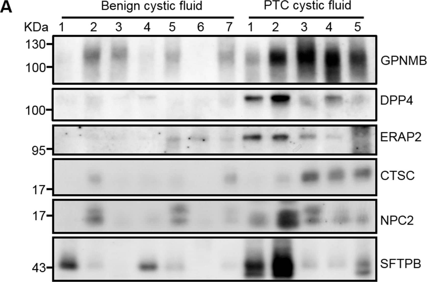 Verification of GPNMB, ERAP2, CTSC, and NPC2 in individual FNA cystic fluid samples by Western blot analysis(A) Equal amounts of proteins (20 μg) prepared from individual FNA cystic fluid samples were separated by 6-18%-gradient SDS-PAGE, transferred to PVDF membranes, and probed with specific antibodies against the indicated target proteins. SFTPB, which was previously reported as a potential PTC biomarker, was also included in this analysis. (B) The Coomassie-Blue-stained protein profile was used as a loading control. Image collected and cropped by CiteAb from the following open publication (//pubmed.ncbi.nlm.nih.gov/29552294), licensed under a CC-BY license. Not internally tested by R&D Systems.