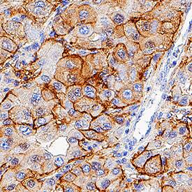Syndecan‑1/CD138 was detected in immersion fixed paraffin-embedded sections of Human Liver using Goat Anti-Human Syndecan‑1/CD138 Biotinylated Antigen Affinity-purified Polyclonal Antibody (Catalog # BAF2780) at 3 &micro;g/mL for 1 hour at room temperature followed by incubation with the Anti-Goat IgG VisUCyte&trade; HRP Polymer Antibody (Catalog # VC004). Before incubation with the primary antibody, tissue was subjected to heat-induced epitope retrieval using VisUCyte Antigen Retrieval Reagent-Basic (Catalog # VCTS021). Tissue was stained using DAB (brown) and counterstained with hematoxylin (blue). Specific staining was localized to cell membrane. View our protocol for IHC Staining with VisUCyte HRP Polymer Detection Reagents.