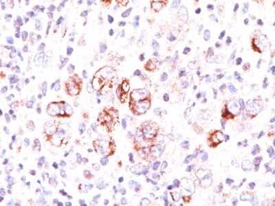 Immunohistochemistry-Paraffin: bcl-x Antibody (2H12) - Azide and BSA Free [NBP2-34531] - FFPE human Hodgkin's lymphoma stained with bcl-x antibody (2H12). Note cytoplasmic and membrane staining.