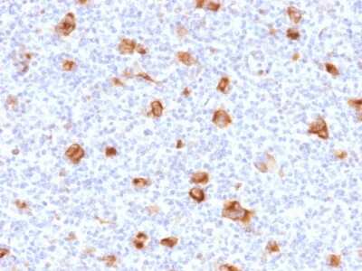 Immunohistochemistry-Paraffin: bcl-x Antibody (SPM519) [NBP3-07417] - Formalin-fixed, paraffin-embedded Hodgkin's lymphoma stained with bcl-x Mouse Monoclonal Antibody (SPM519).