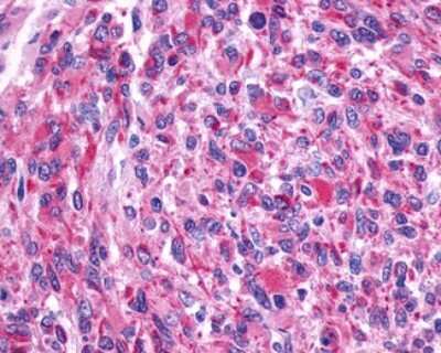 Immunohistochemistry-Paraffin: beta-2 Adrenergic R/ADRB2 Antibody [NLS2656] - Analysis of anti-ADRB2 antibody with human brain, glioblastoma.