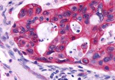 Immunohistochemistry-Paraffin: beta-2 Adrenergic R/ADRB2 Antibody [NLS2656] - Human Colon, Carcinoma formalin-fixed, paraffin-embedded tissue after heat-induced antigen retrieval.
