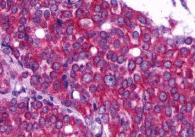 Immunohistochemistry-Paraffin: beta-2 Adrenergic R/ADRB2 Antibody [NLS2656] - Human Prostate, Carcinoma formalin-fixed, paraffin-embedded tissue after heat-induced antigen retrieval.