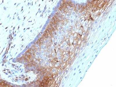 Immunohistochemistry-Paraffin: beta 2-Microglobulin Antibody (B2M/1118) - Azide and BSA Free [NBP2-47702] - Human Cervical Carcinoma stained with Beta-2-Microglobulin Monoclonal Antibody (B2M/1118)