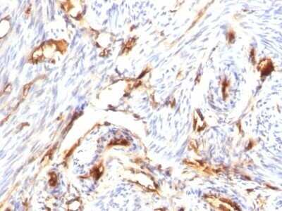 Immunohistochemistry-Paraffin: beta 2-Microglobulin Antibody (B2M/1118) - Azide and BSA Free [NBP2-47702] - Human Endometrial Carcinoma stained with Beta-2-Microglobulin Monoclonal Antibody (B2M/1118)