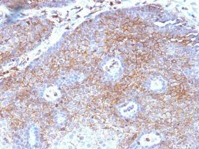 Immunohistochemistry-Paraffin: beta 2-Microglobulin Antibody (B2M/1118) - Azide and BSA Free [NBP2-47702] - Human Cervical Carcinoma stained with Beta-2-Microglobulin Monoclonal Antibody (B2M/1118)