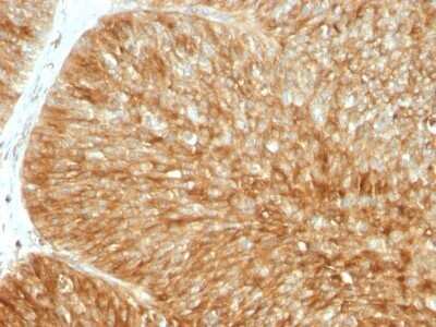 Immunohistochemistry-Paraffin: beta 2-Microglobulin Antibody (B2M/961) - Azide and BSA Free [NBP2-47704] - Human Bladder Carcinoma stained with Beta-2-Microglobulin Monoclonal Antibody (B2M/961)