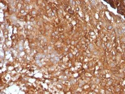Immunohistochemistry-Paraffin: beta 2-Microglobulin Antibody (B2M/961) - Azide and BSA Free [NBP2-47704] - Human Melanoma stained with Beta-2-Microglobulin Monoclonal Antibody (B2M/961).