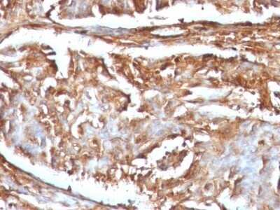 Immunohistochemistry-Paraffin: beta 2-Microglobulin Antibody (B2M/961) - Azide and BSA Free [NBP2-47704] - Human Renal Carcinoma stained with Beta-2-Microglobulin Monoclonal Antibody (B2M/961)